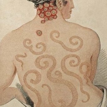 psoriasis as drawings and photographs